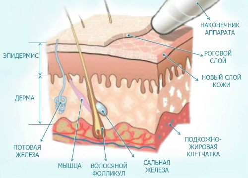 Mikrodermabrazia-2