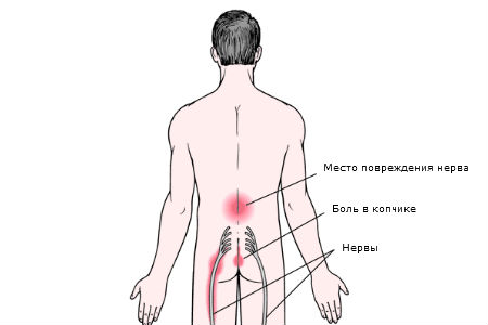 Пояснично-крестцовый-радикулит