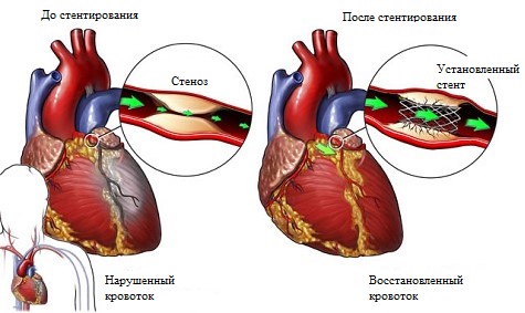 Стентирование сосудов сердца до и после
