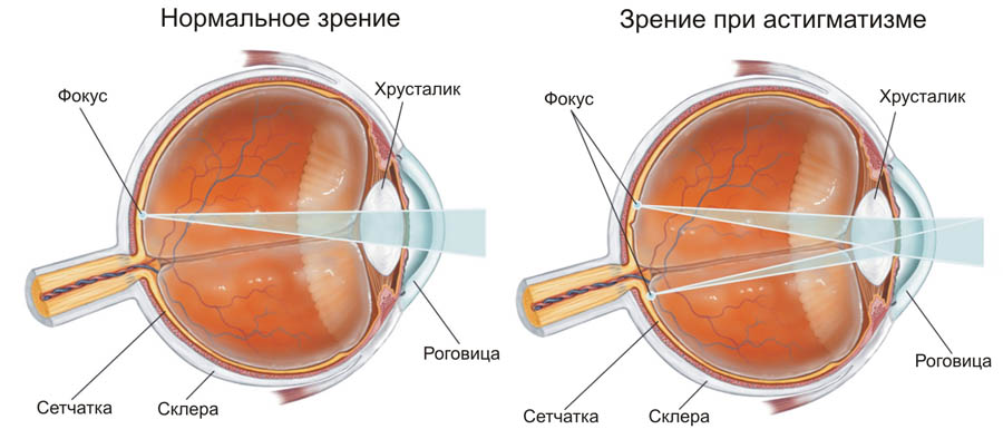 astigmatizm Астигматизм фото