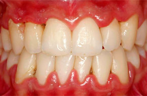 gingivit1