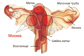 mioma