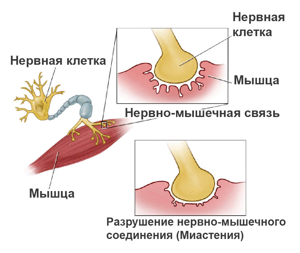 myasthenia-gravis-168639