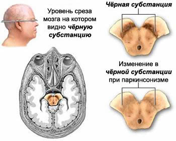 parkinson