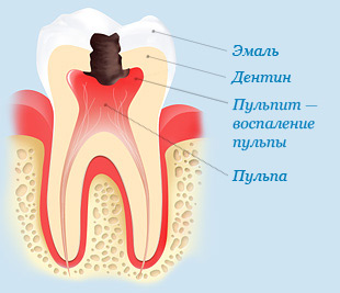 pulpitis_54