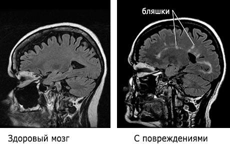rasseyanniy-skleroz-diagnostika