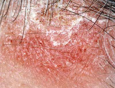 seb_dermatitis