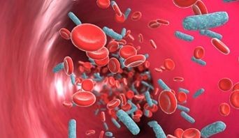 sepsis-septicaemia