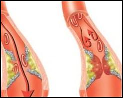 thrombosis