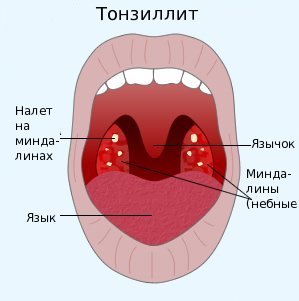 tonzillit-pri-bieriemiennosti-2
